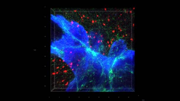 EPFL, synapses in breast tumor, AI, medicine